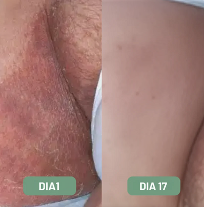 Jabón Antifúngico – Protección Diaria para la Piel 🎁 Llévate un Blanqueador Dental V34 100% GRATIS